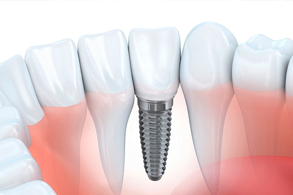 implantes dentales en lima peru