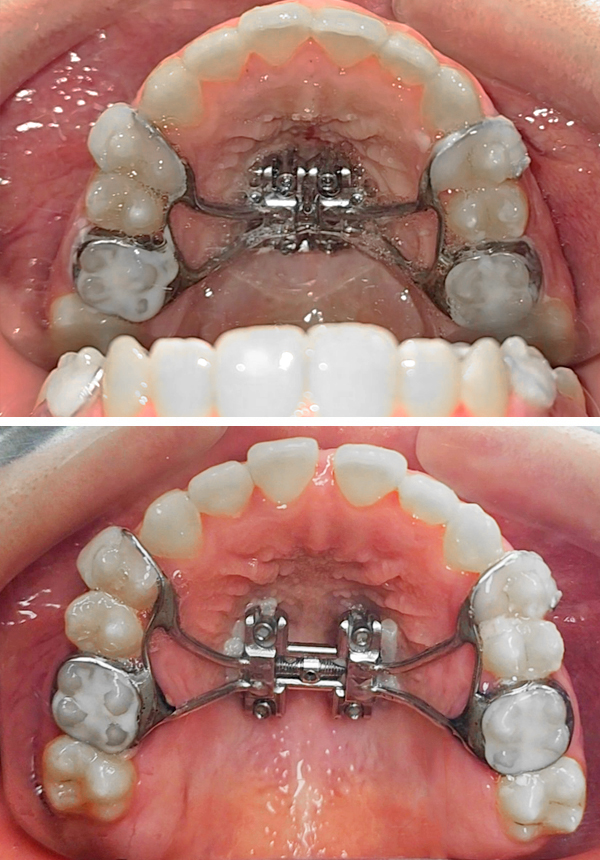 mover dientes, bandas, micro implantes, brackets autoligables, brackets esteticos, brackets de zafiro , ortodoncia en lima, espelistas en ortodoncia, enderezamiento de molares, molares lingualizados, 