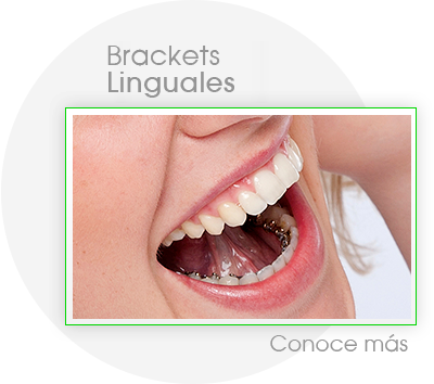 ortodoncia lingual, brackets internos, brackets linguales, ortodoncia invisible, brackets que no se notan, correctores bucales