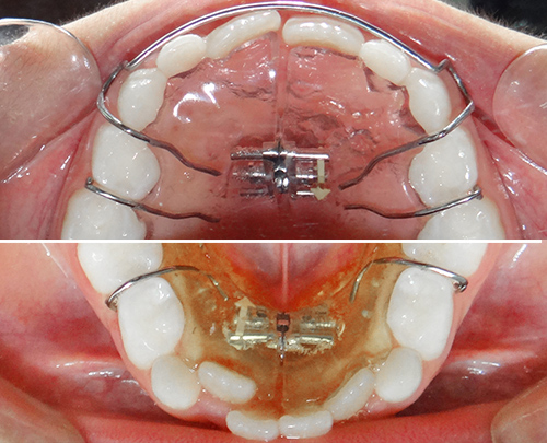 esfactor maxilar, ortopedia dentofacial, paladar estrecho, aparato expansor, tipos de aparatos dentales, expansion rapida, ortodoncia removible, expansor de paladar